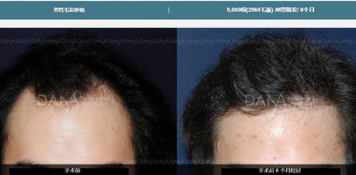 韩国多娜M型脱发移植真人案例对比