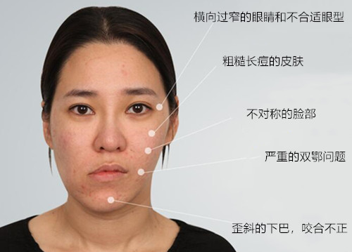 韩国菲斯莱茵李真秀,面部轮廓矫正案例分析