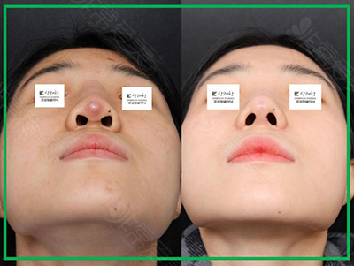 韩国清新整形外科鼻部假体外露修复日记图