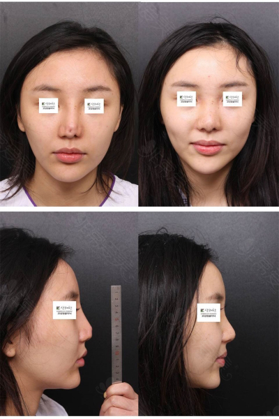 韩国清新整形外科鼻尖重建前后对比照片
