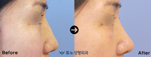 韩国朱诺整形鼻梁高低不平修复案例
