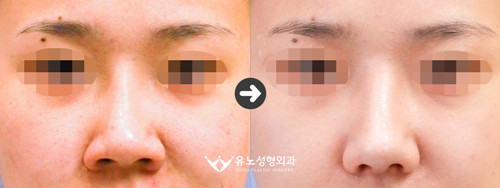韩国朱诺整形鼻翼修复案例