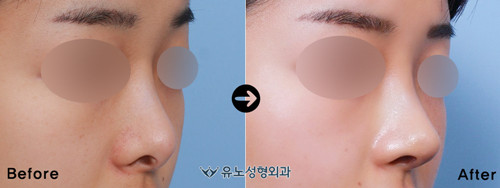 韩国朱诺整形鼻尖下垂修复案例