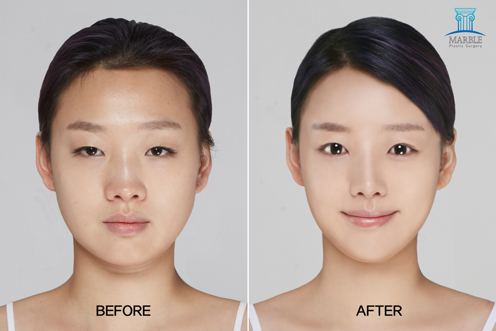 韩国玛博尔整形外科双眼皮整形案例