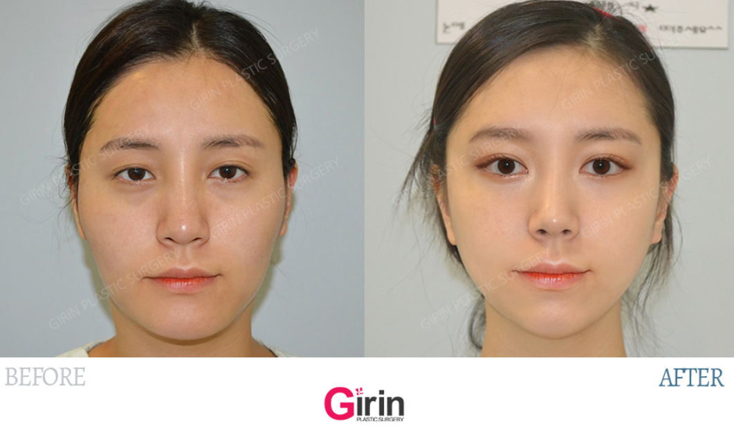 韩国绮林整形外科双眼皮整形案例