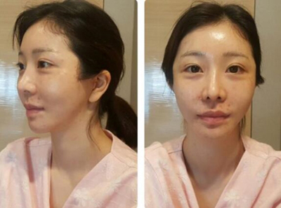 韩国维摩整形医院全脸脂肪填充术前照片