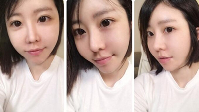 韩国维摩整形医院全脸脂肪填充术后照片