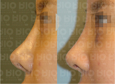 韩国BIO整形医院鼻修复对比图