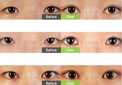 韩国JELIM整形外科眼部手术照片