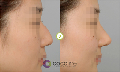 韩国cocoline鼻部整形照片