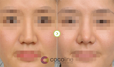 韩国cocoline自体软骨隆鼻案例