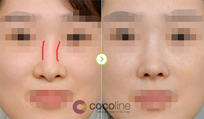 韩国cocoline鼻修复案例图