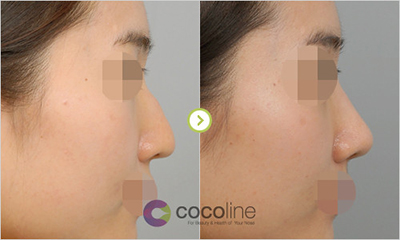 韩国cocoline整形外科隆鼻照片