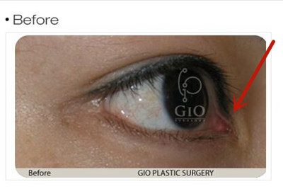 韩国GIO整形外科车知勳修复失败眼角案例，帮你重拾自信！