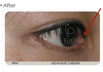 韩国GIO眼部修复案例内眼角