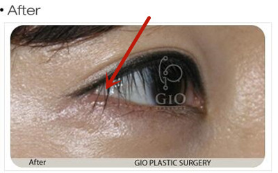 韩国GIO整形外科眼部修复案例