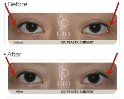 韩国GIO整形外科外眼角、双眼皮修复案例