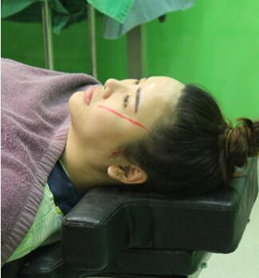 韩国丽珍整形外科颧骨整形手术照片