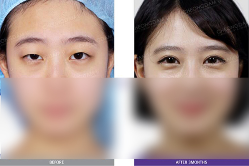 韩国清潭优整形外科眼部手术案例