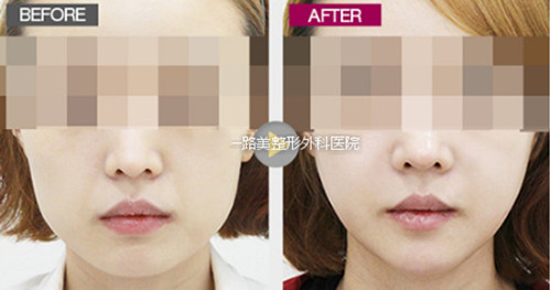 韩国一路美整形外科下颌角手术真人案例