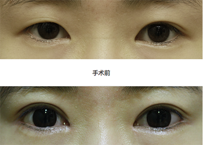 双眼皮手术+开外眼角术手术案例