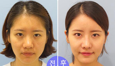 韩国美自人整形外科隆鼻前后对比照