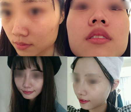 韩国吴世元整形外科隆鼻案例案例对比图