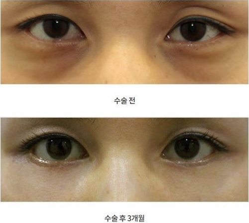 韩国右手整形外科眼底脂肪重置手术案例