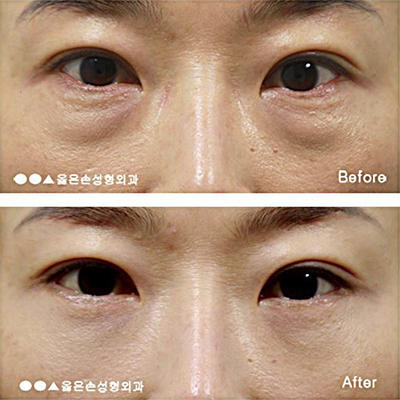 韩国右手整形外科下眼睑矫正手术案例