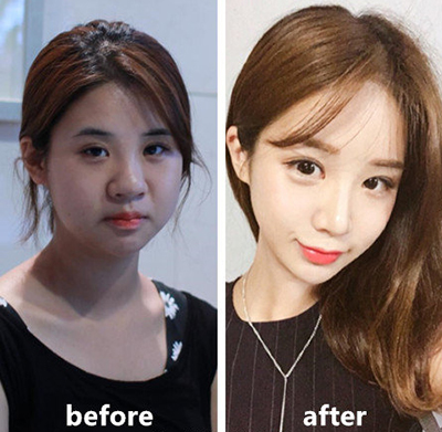 韩国然美之整形外科面部整形前后对比照