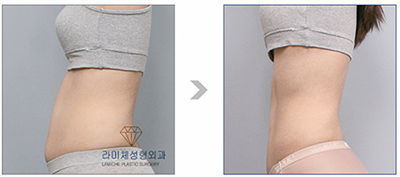 韩国然美之整形腰腹吸脂案例对比图