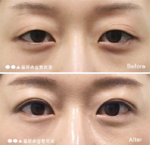 韩国右手整形外科双眼皮手术对比日记