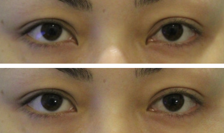 前眼角修复手术案例