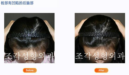 韩国雕刻整形外科后脑勺填充对比