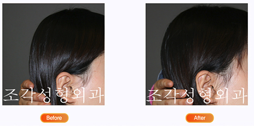 韩国雕刻整形外科后脑勺填充前后对比照