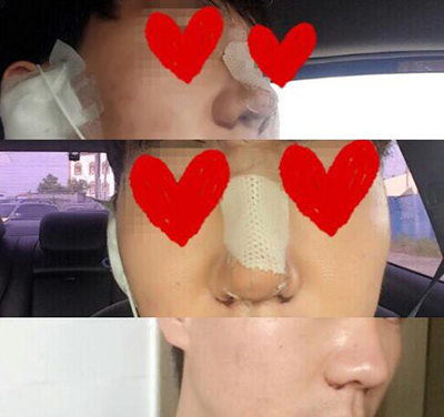 韩国秀雅倍SUAVEL整形外科隆鼻前后照片