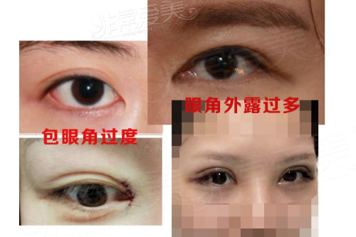 功课分析内眼角修复哪家好，附韩国7个眼角修复医院名单