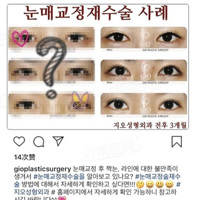 韩国gio整形医院包眼角修复案例