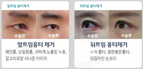 韩国swan眼角修复案例图