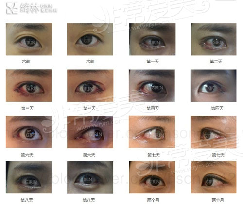 韩国绮林整形包眼角修复全过程图片
