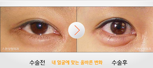 韩国天鹅(Swan)整形外科眼角修复案例