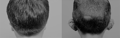 韩国普露菲耳双耳畸形再造手术对比案例