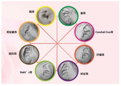 耳畸形是怎么引起的？揭秘手术做耳朵畸形再造修复什么样