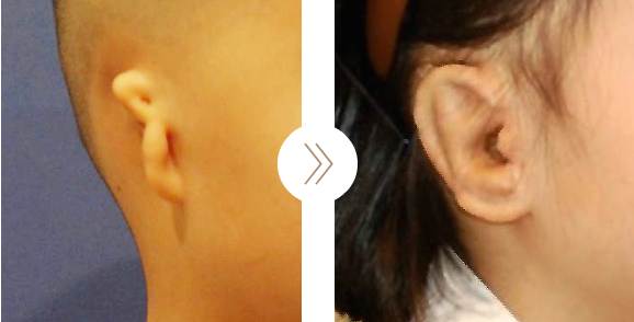 韩国profile整形外科耳畸形矫正