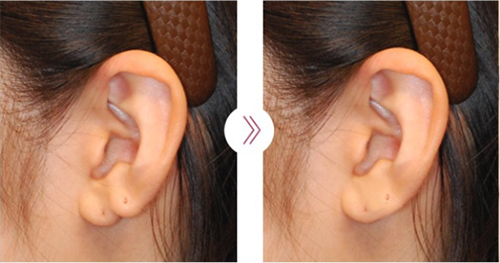 韩国普露菲耳耳畸形矫正对比