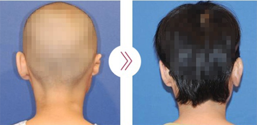 韩国普露菲耳耳畸形矫正手术