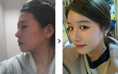 韩国Noble＆Cosmo整形外科隆鼻前后对比照片
