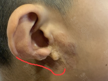 耳萎缩缺失部位示意图