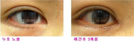 韩国夏娃整形医院眼角修复怎么样？医生实力+日记效果曝光