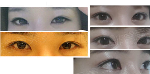 韩国gio眼睛修复对比